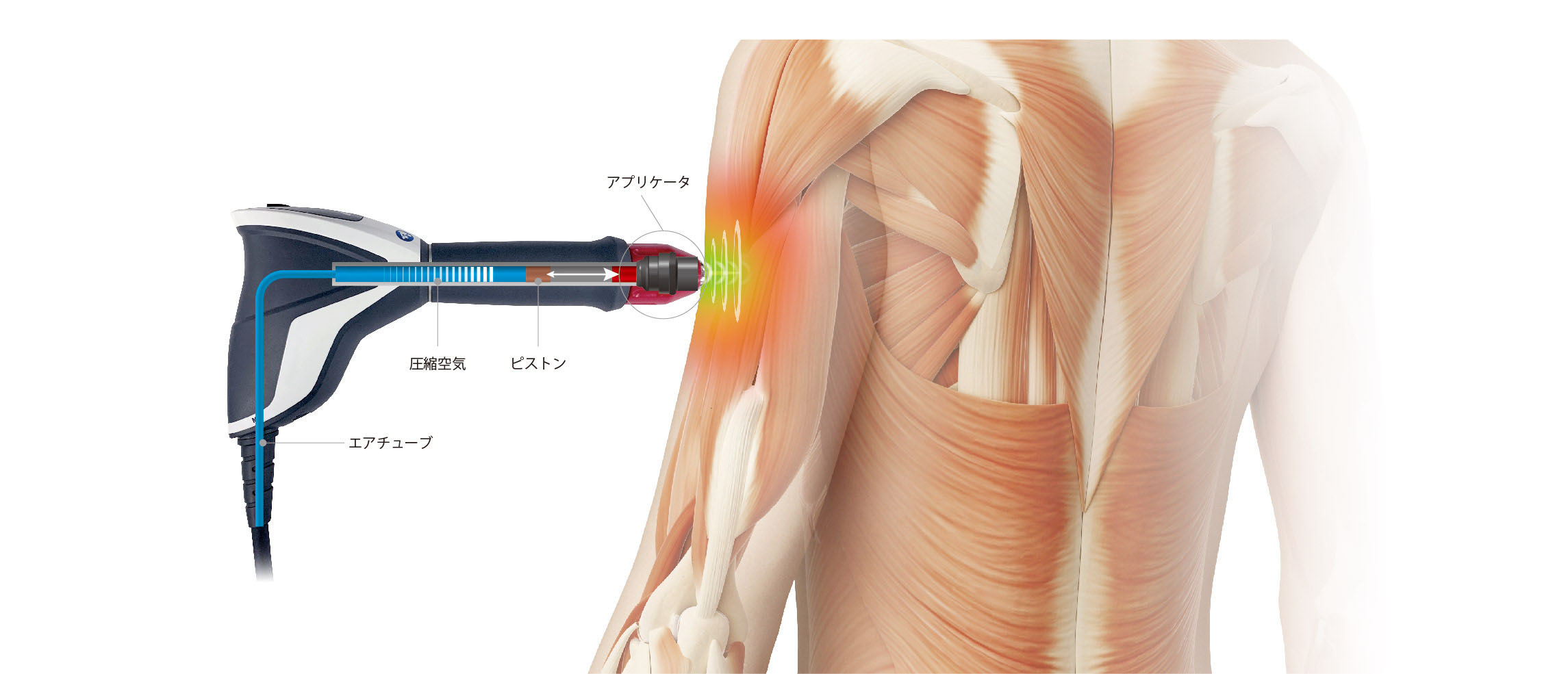 拡散型圧力波治療器SHOCKMASTER（ショックマスター）導入 | ふなき接骨院 津田沼